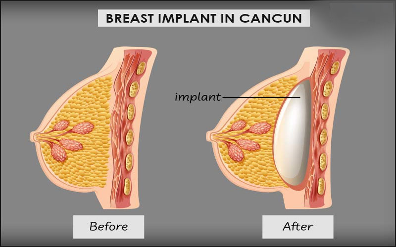 What Exactly ARE Breast Implants?
